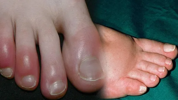 swollen