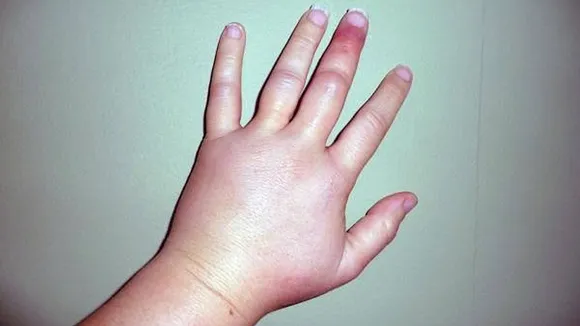 swollen finger tips