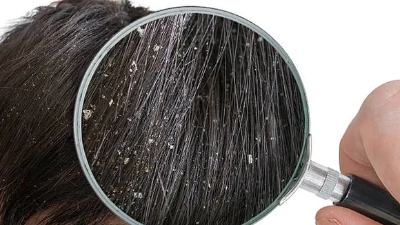 Dandruff Treatment and Remedies