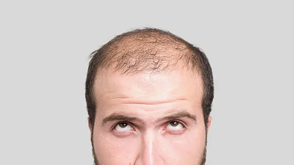 Baldness