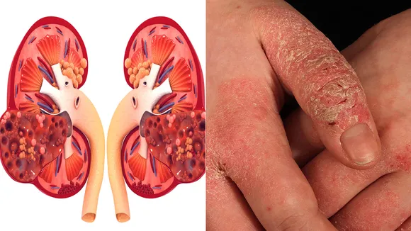 kidney