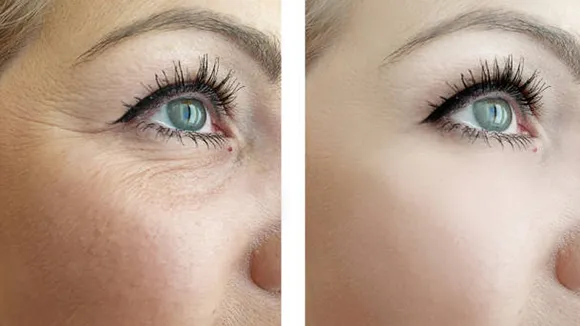 Wrinkles Treatment at Home