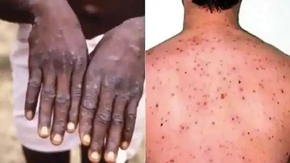Monkeypox