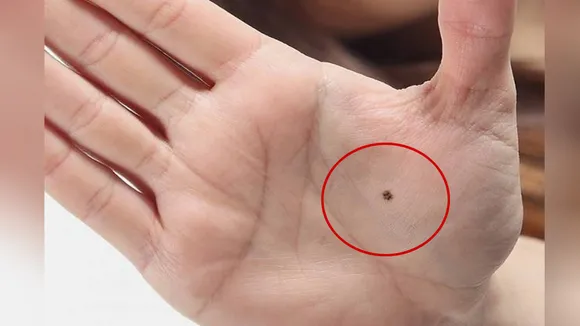 Mole on Palm