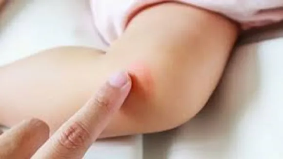 rashes