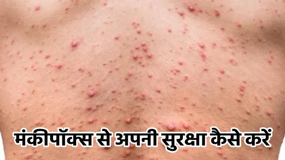monkey pox  1