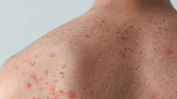 monkeypox