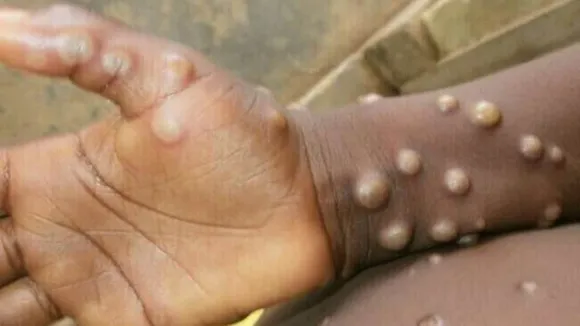 monkeypox