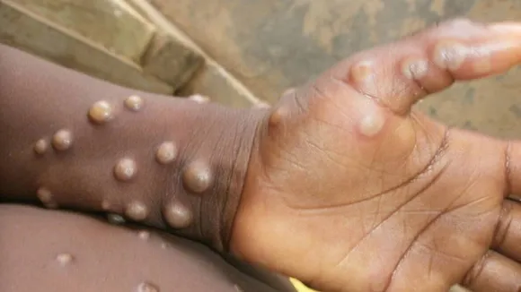 Monkeypox