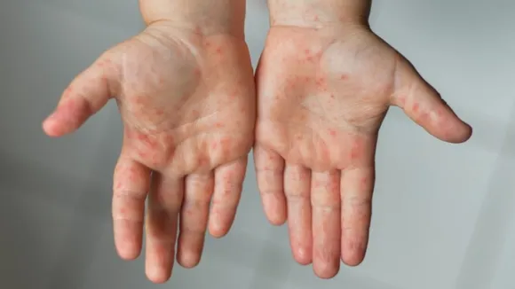 Monkeypox