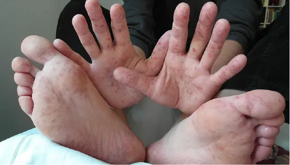 Hand Fooot Mouth