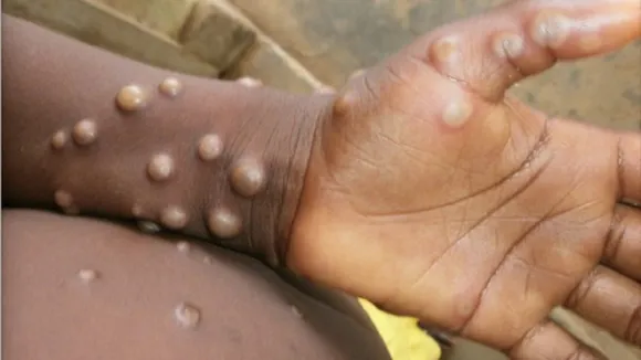 monkey pox