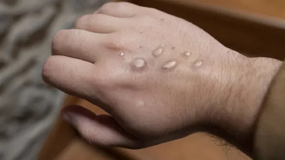Monkeypox