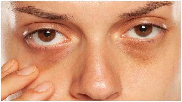 How To Get Rid Of Dark Circles