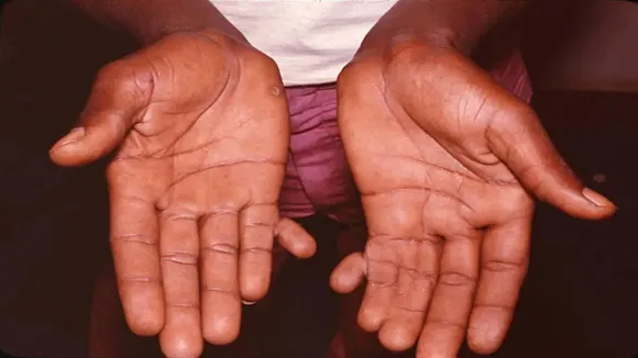 Six Fingers In Hand
