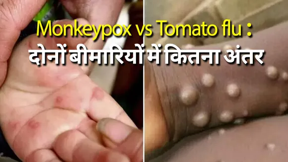 monkeypox