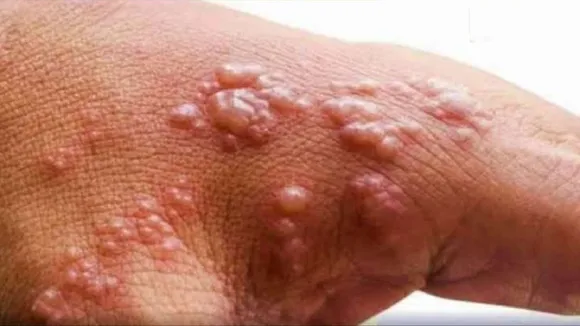 Monkeypox case