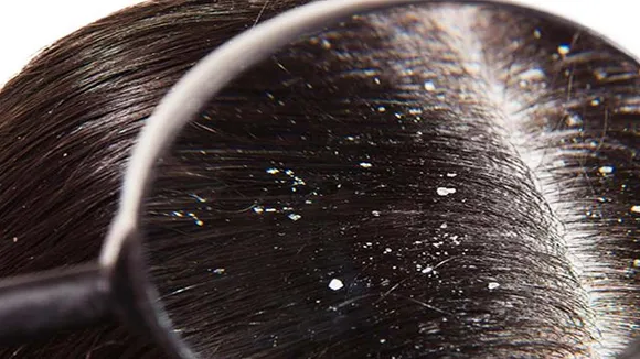Dandruff Treatment At Home