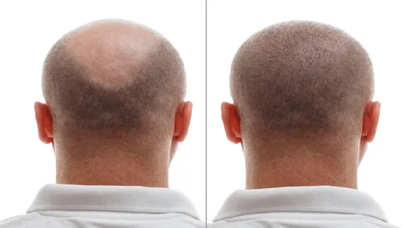 Hair Transplant