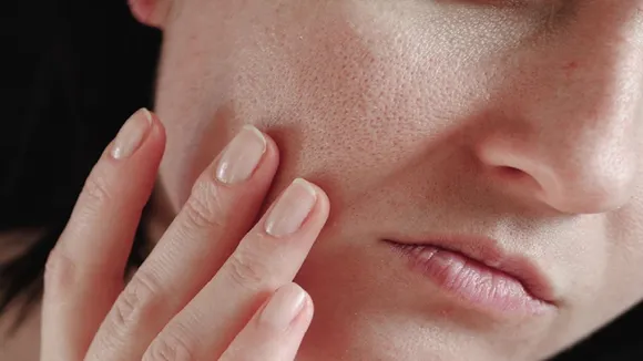 dry skin