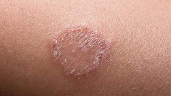 Fungal Infection
