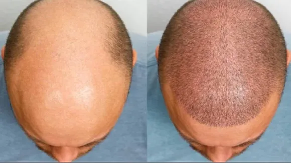 BALD