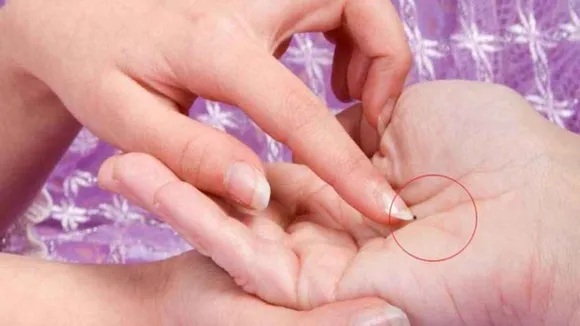 mole on palm