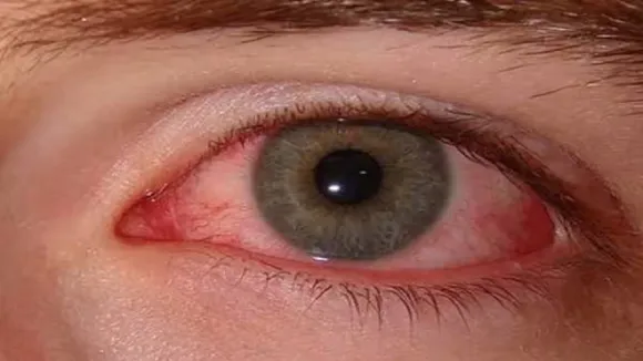 eye flu problem