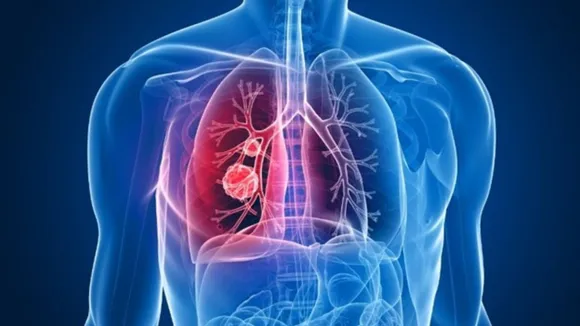 Lung Cancer