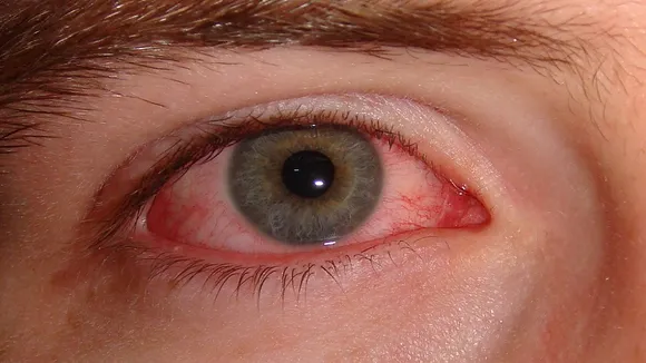 eye flu