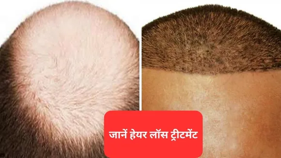 Hair Transplant