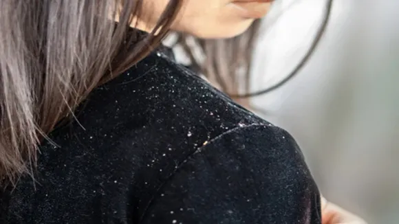 Home remedies For Dandruff