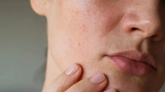 skin diseases