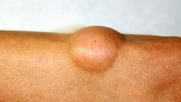 lipoma