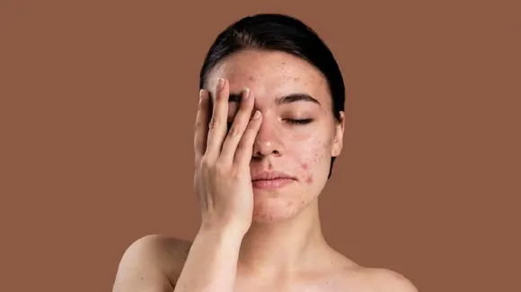 Pimples on Face