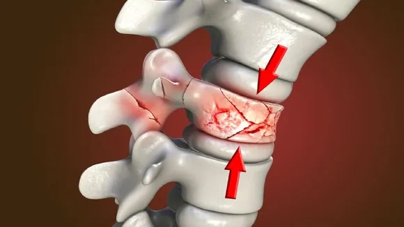 symptoms of Osteoporosis