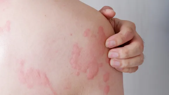 aquagenic urticaria symptoms