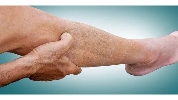 Peripheral Artery Disease