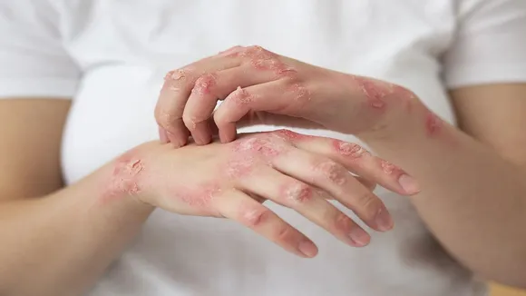 Symptoms of Leprosy