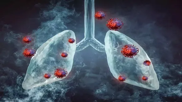 Tuberculosis