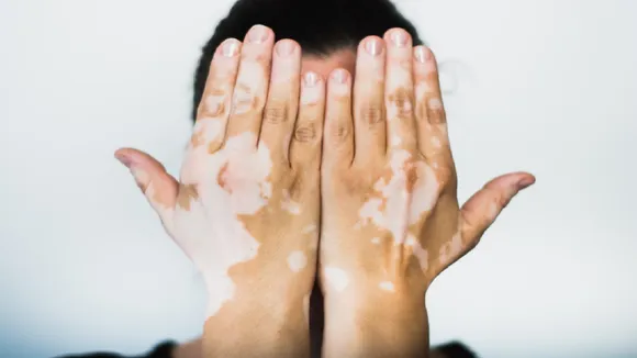 Symptoms of Leucoderma