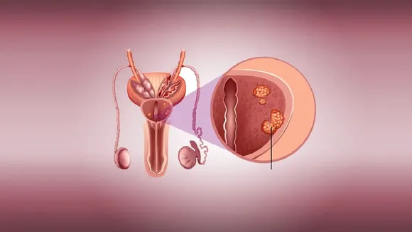 Prostate Cancer
