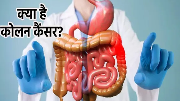 colon cancer