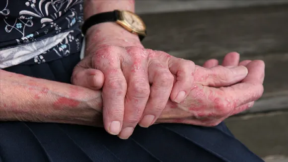 Pellagra