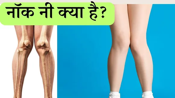 Knock Knees