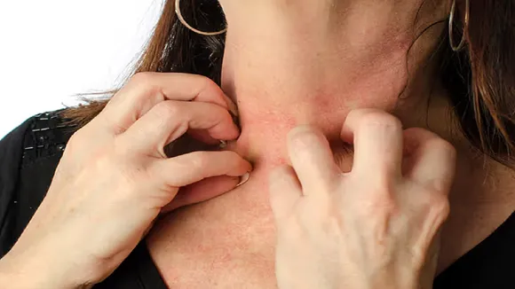 What is Anaphylaxis