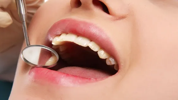 What Is Mouth Stone