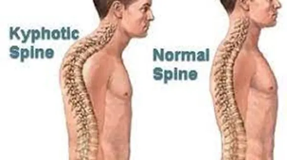 what is kyphosis know its symptoms causes and treatment