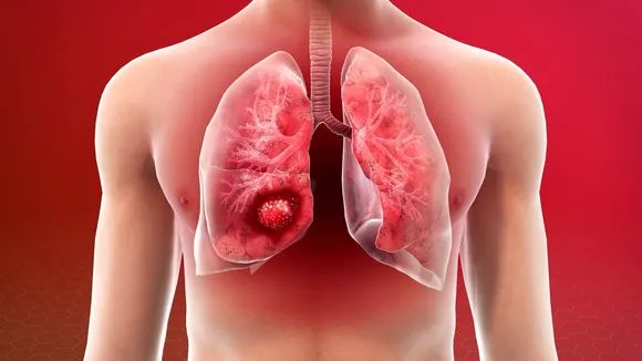 Lung Cancer