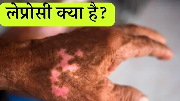 leprosy disease
